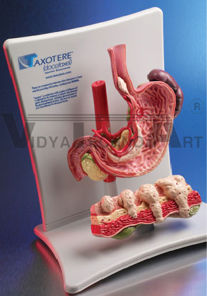 Stomach Cancer Model